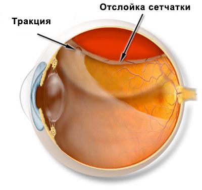 Відшарування сітківки ока симптоми, що це таке, операція, лікування, народними засобами