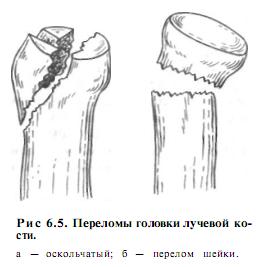 Переломи головки і шийки променевої кістки - травматологія та ортопедія, травми і лікування верхньої