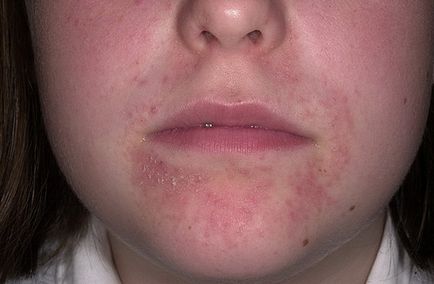 Dermatita dermală - cauze și trăsături de tratament