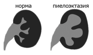 Pyelectasia плода и от двете страни, какво е това и причините за
