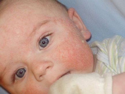 Élelmiszer allergia csecsemők kezelésére és fotó