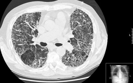 Pneumofibroza pulmonară este ceea ce este și cum să o vindeci complet