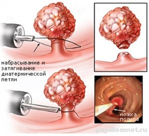 Polipi în tratamentul uterului în clinică și acasă