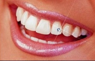 Obțineți cupoane de reducere pentru albirea dinților