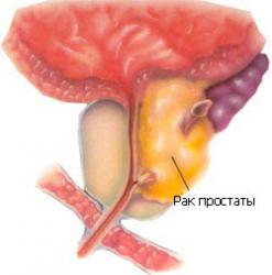 Consecințe și complicații ale inflamației prostatice, adenomului prostatic și prostatitei