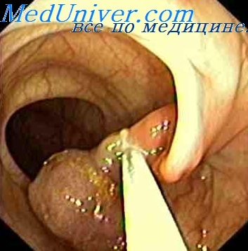 Postoperatorie de polipectomie