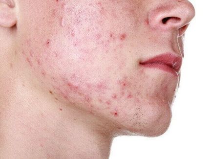 A megfelelő táplálkozás, amikor Demodex 1 (helyes) Helyes táplálkozás Demodex 1