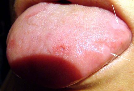 Semne ale bolii prin apariția limbii