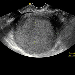 Simptomele endometriozei cervicale, uzi pentru toți!