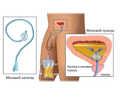 Vesicoclysis keresztül tsistostomu