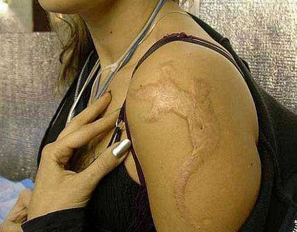 Provocarea cancerului de piele poate fi îndepărtarea tatuajelor, ABC de sănătate