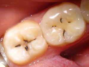 Psihosomatica carii, stomatologie holistica