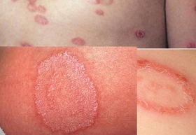 Petele de pe piele se aseamănă cu fotografii lichenice, boli posibile, tratament, boli fungice