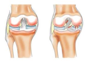 Реабілітація після розриву менісків колінного суглоба, новий крок