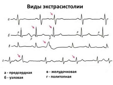 Simptomele și tratamentul extrasistolului