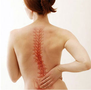 Scolioza coloanei vertebrale toracice - cum se trateaza