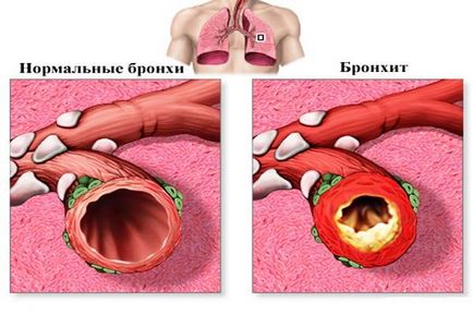 Сода при кашлі (бронхіті) рецепти по застосуванню