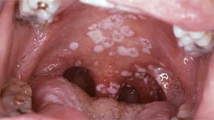 Stomatitis kezelésére, a tünetek, okok, típusú és fotó stomatitis, Krasznojarszk