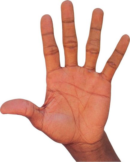 Száraz ekcéma a kéz és tüneteinek kezelésére tiloticheskoy forma