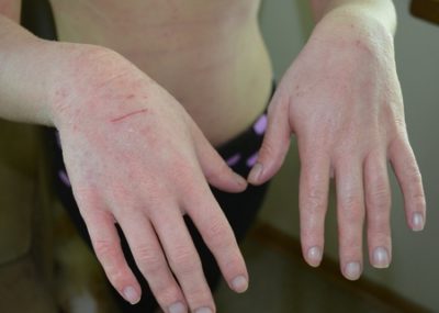 Сухість шкіри на руках причини появи тріщин, сухості, лікування тріщин на руках, крему від сухості