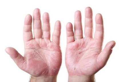 Bőrszárazság a kézen okoz repedés, szárazság, repedés kezelési kar, krémek kiszáradását
