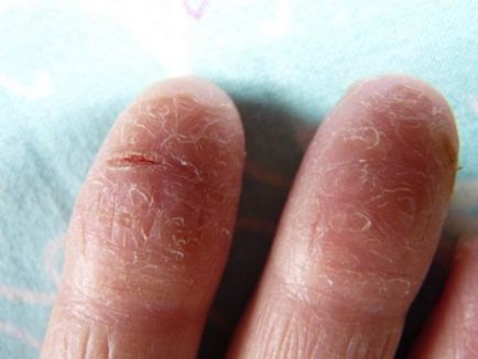 Сухість шкіри на руках причини появи тріщин, сухості, лікування тріщин на руках, крему від сухості