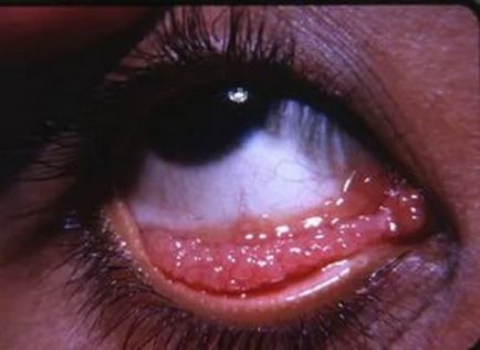 Trachoma - cauze, simptome, diagnostic și tratament