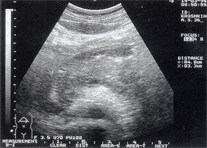 Diagnosticul ultrasonic al pancreatitei acute si a complicatiilor sale - mogota m