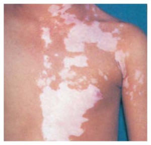 Urotropină în vitiligo - proprietăți ale medicamentului și utilizarea acestuia