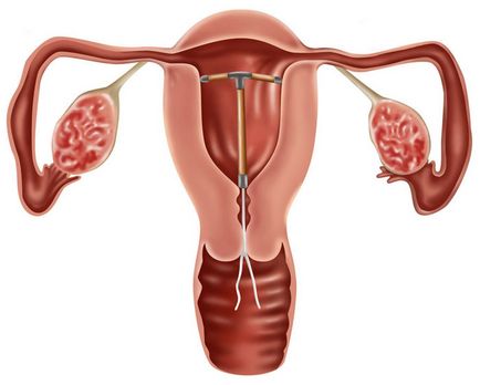 Внутрішньоматкові методи контрацепції (спіраль) показання, протипоказання, ефективність, medjournal