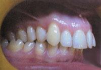 Ortodontológus, nadrágtartó, fogszabályozás