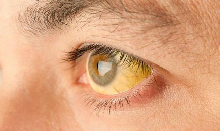 Жовті склери - причини появи симптому, способи лікування