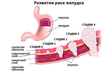 Rosszindulatú daganatok a gyomorban, amely életesélyek