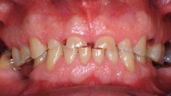 Mâncărimea gingiilor posibile boli și moduri de tratament, de ce gingii rănit