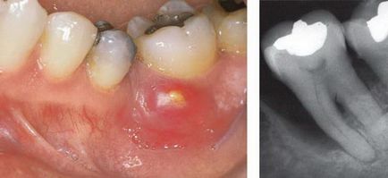 Parodontita abcesivă - enciclopedie a stomatologiei