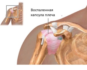 Capsula adezivă a articulațiilor umărului, tratament, exerciții