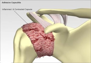 Capsula adezivă a articulațiilor umărului, tratament, exerciții