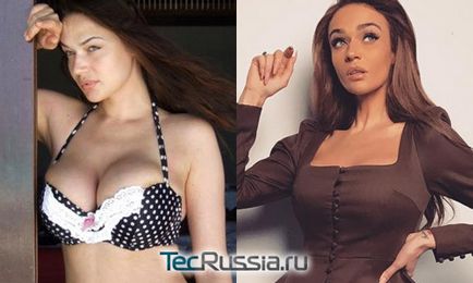 Alena Vodonayeva și-a redus sânii la 2 dimensiuni - înainte și după fotografierea chirurgiei plastice