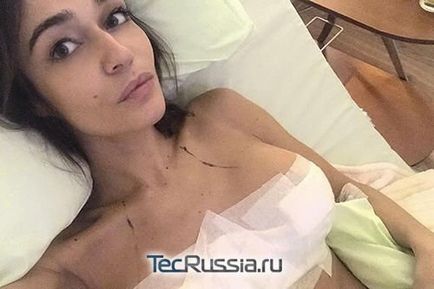 Alain Vodonaeva mellkisebbedés 2 - fotók előtt és után plasztikai sebészet