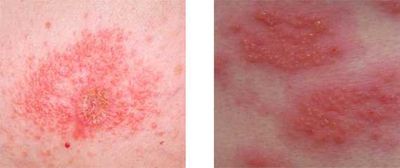 Dermatita alergică