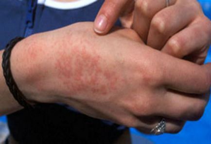 Atópiás dermatitis tünetei és kezelése felnőttek és gyermekek (tünetek) Atópiás dermatitis tünetei és kezelése felnőttek és gyermekek