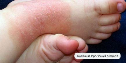 Dermatita alergică simptomatică și tratament la adulți și copii