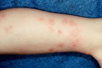 Dermatita alergică simptomatică și tratament la adulți și copii