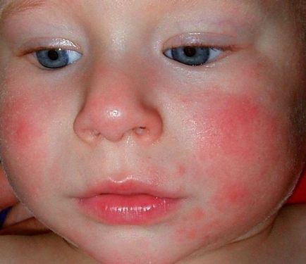Алергічний дерматит симптоми і лікування у дорослих і дітей