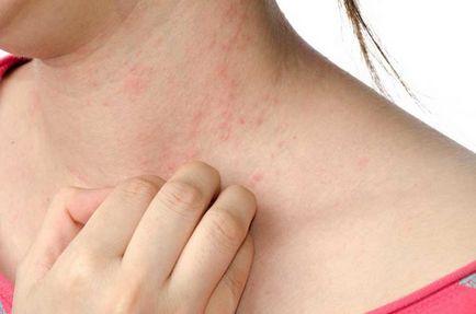 Alergia la mușcăturile de țânțari la adulți este cum să recunoaștem, decât să tratăm (inclusiv remediile populare),