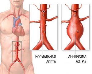 Anevrismul simptomelor aortei abdominale, diagnosticul de anevrisme, artere, intervenții chirurgicale vasculare, spb