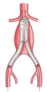 Anevrismul simptomelor aortei abdominale, diagnosticul de anevrisme, artere, intervenții chirurgicale vasculare, spb