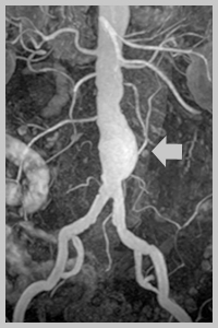 Anevrismul simptomelor aortei abdominale, diagnosticul de anevrisme, artere, intervenții chirurgicale vasculare, spb