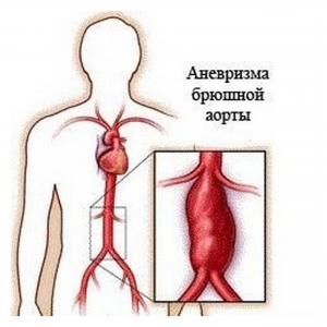 Аневризма поняття, види, способи лікування і профілактика захворювання