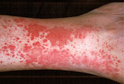 Vasculitis A bőr vasculitis - kezelés a szív (érgyulladás bőr vasculitis) Vasculitis A bőr vasculitis - kezelés a szív